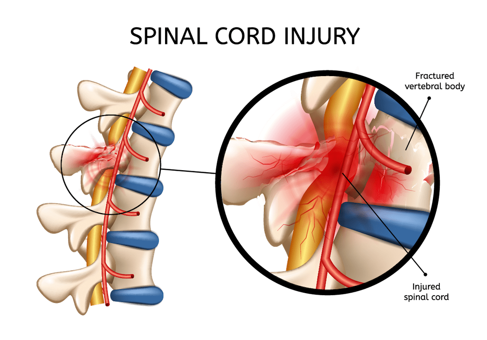 Sciatica Treatment in Singapore - Oxford Spine & Neuro