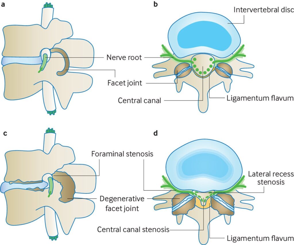 Lumbar Spinal Stenosis - Oxford Spine & Neuro