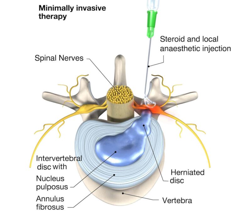 Sciatica Treatment in Singapore - Oxford Spine & Neuro