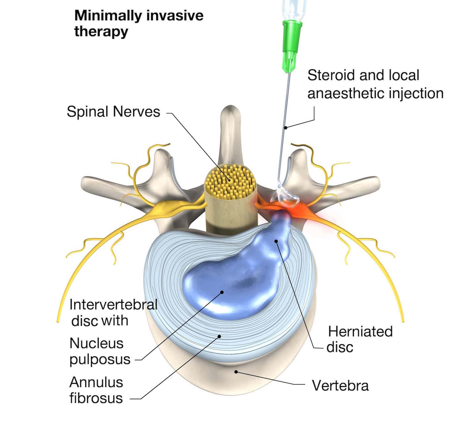 Sciatica Treatment In Singapore - Oxford Spine & Neuro