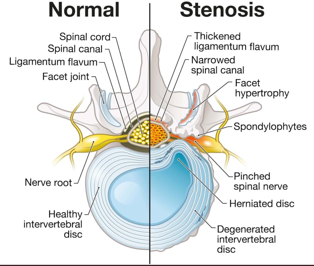 Symptoms of Lumbar Spinal Stenosis