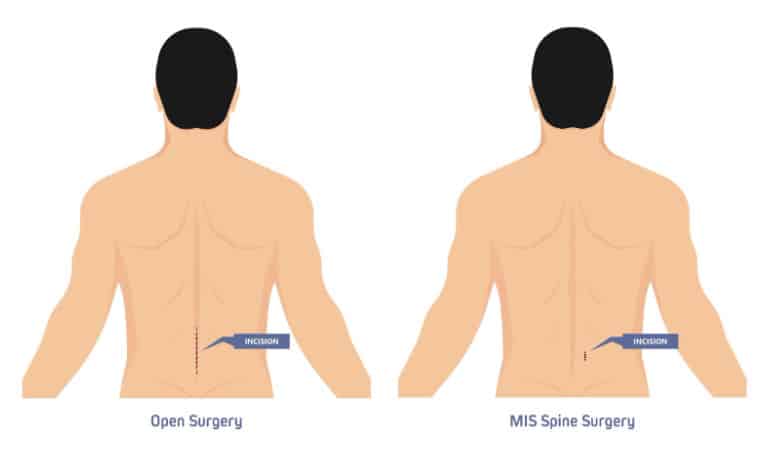 Open Surgery - MIS Spine Surgery