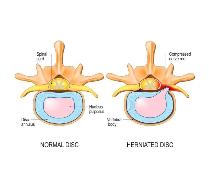 Normal disc and herniated disc comparison