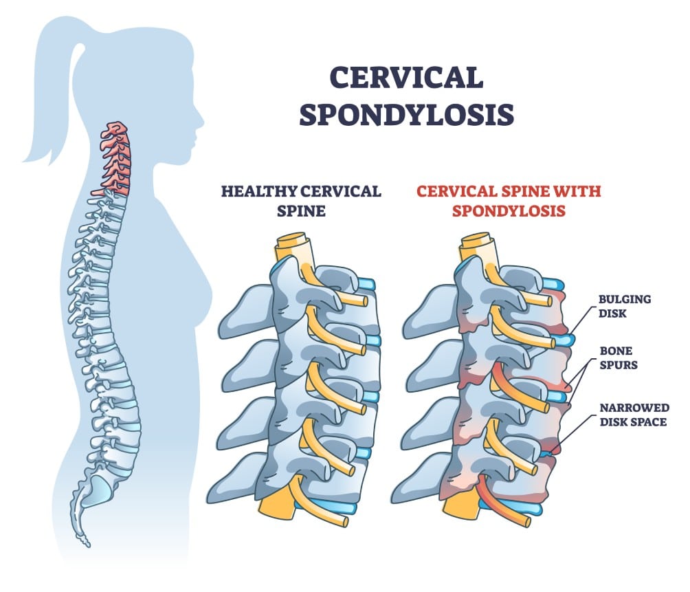 Cervical & Lumbar Spondylosis Treatment Singapore