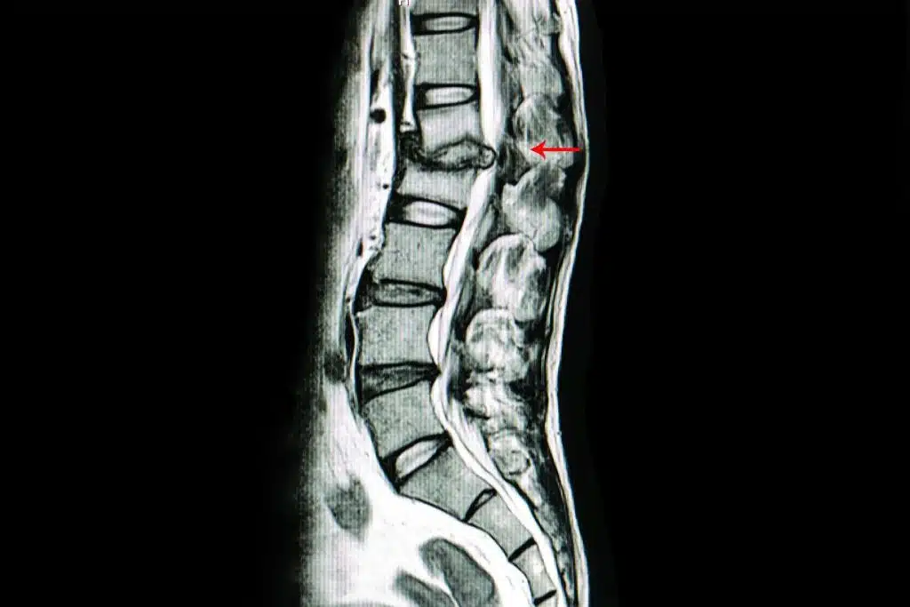 Spinal Infections - Oxford Spine & Neuro
