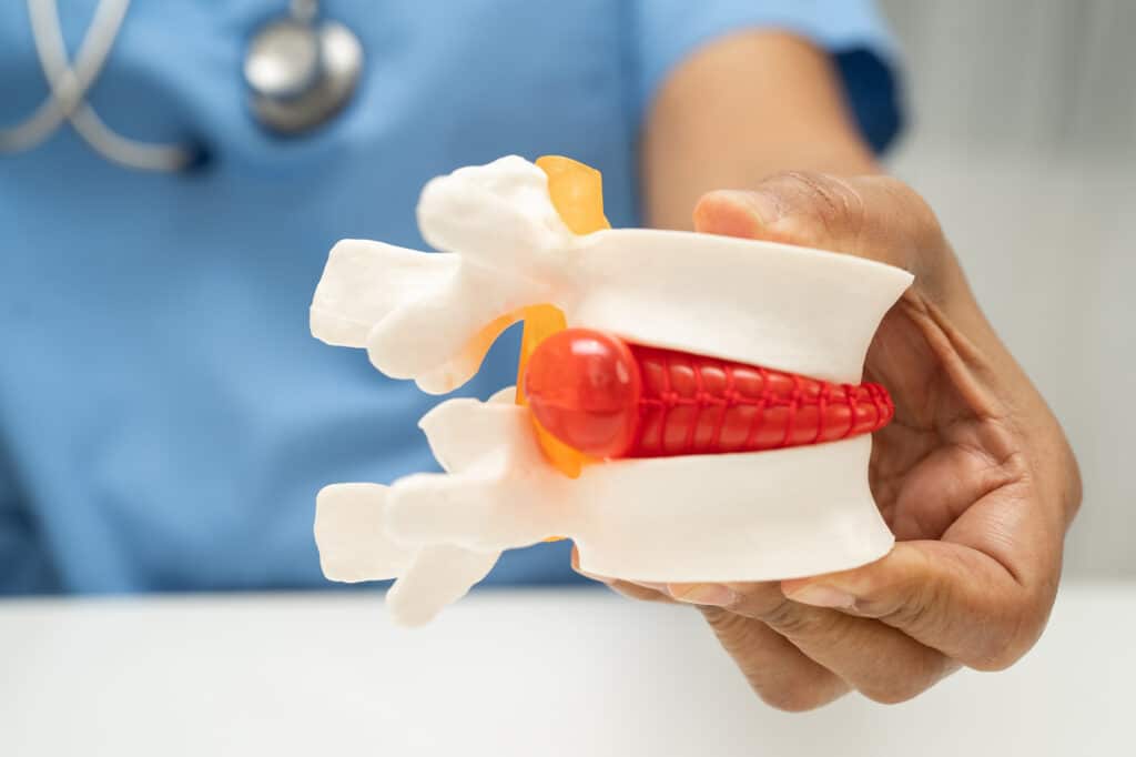 Asian doctor holding spinal nerve and bone model, Lumbar spine displaced herniated disc fragment for treatment medical in the orthopedic department.