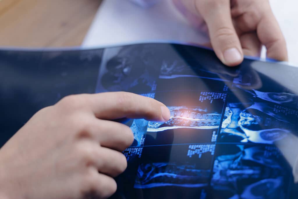 A doctor examining an MRI scan of a spinal column