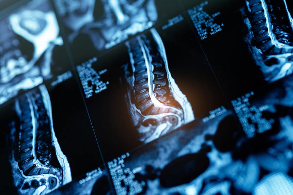 Results of a spine scan