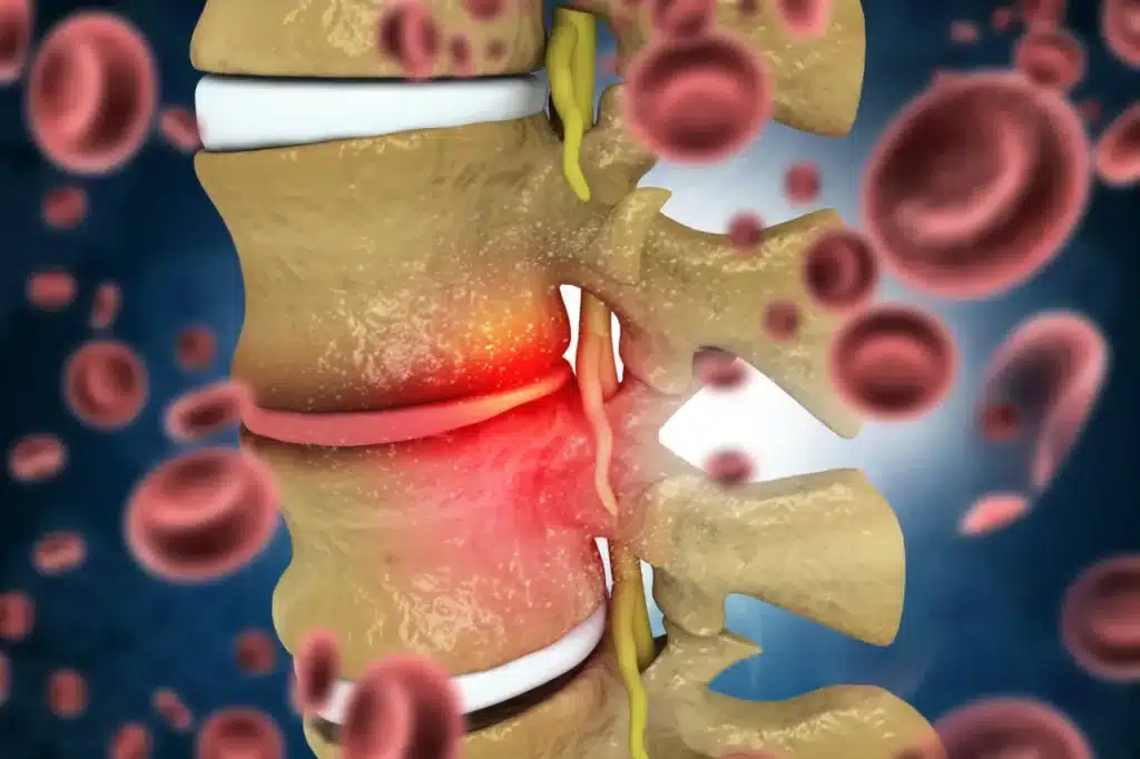 3D medical illustration of a lumbar slipped disc pressing on a spinal nerve root