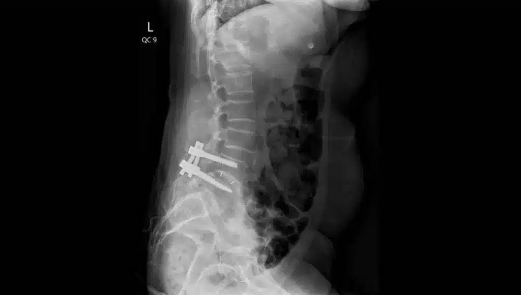 X-Ray showing spine implant